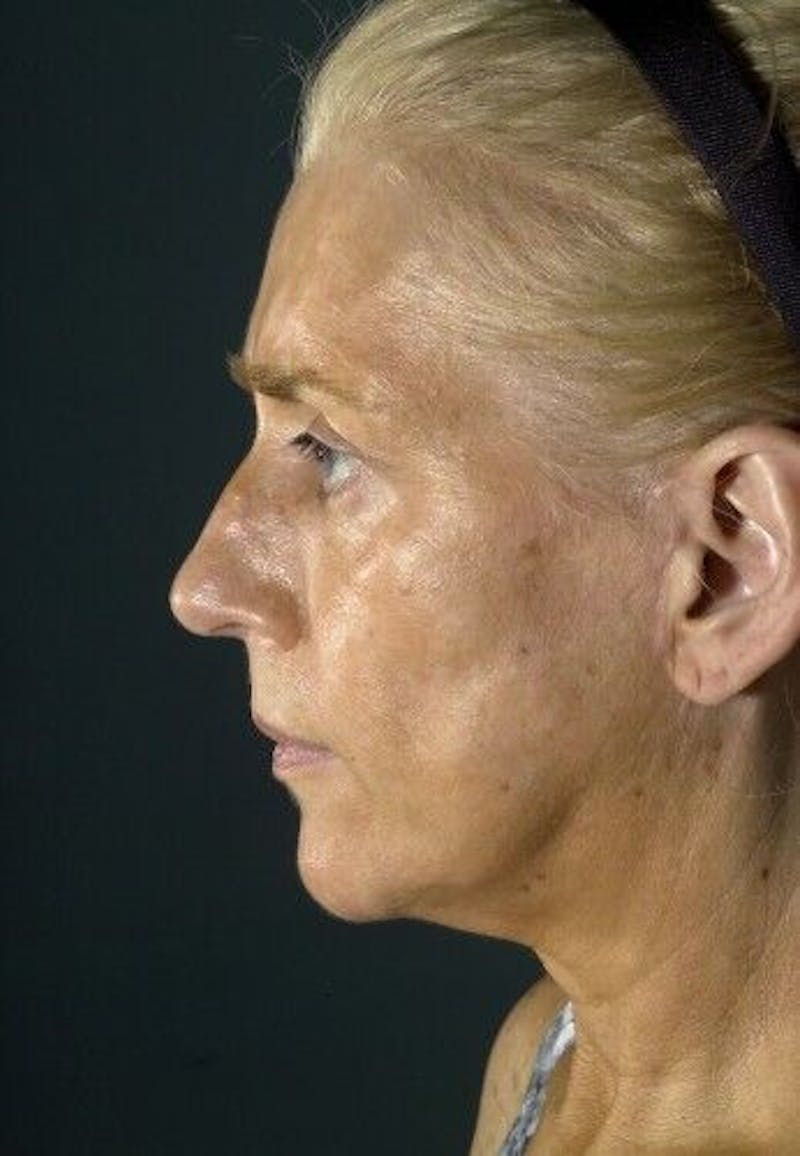 Facelift Before & After Gallery - Patient 55345573 - Image 6