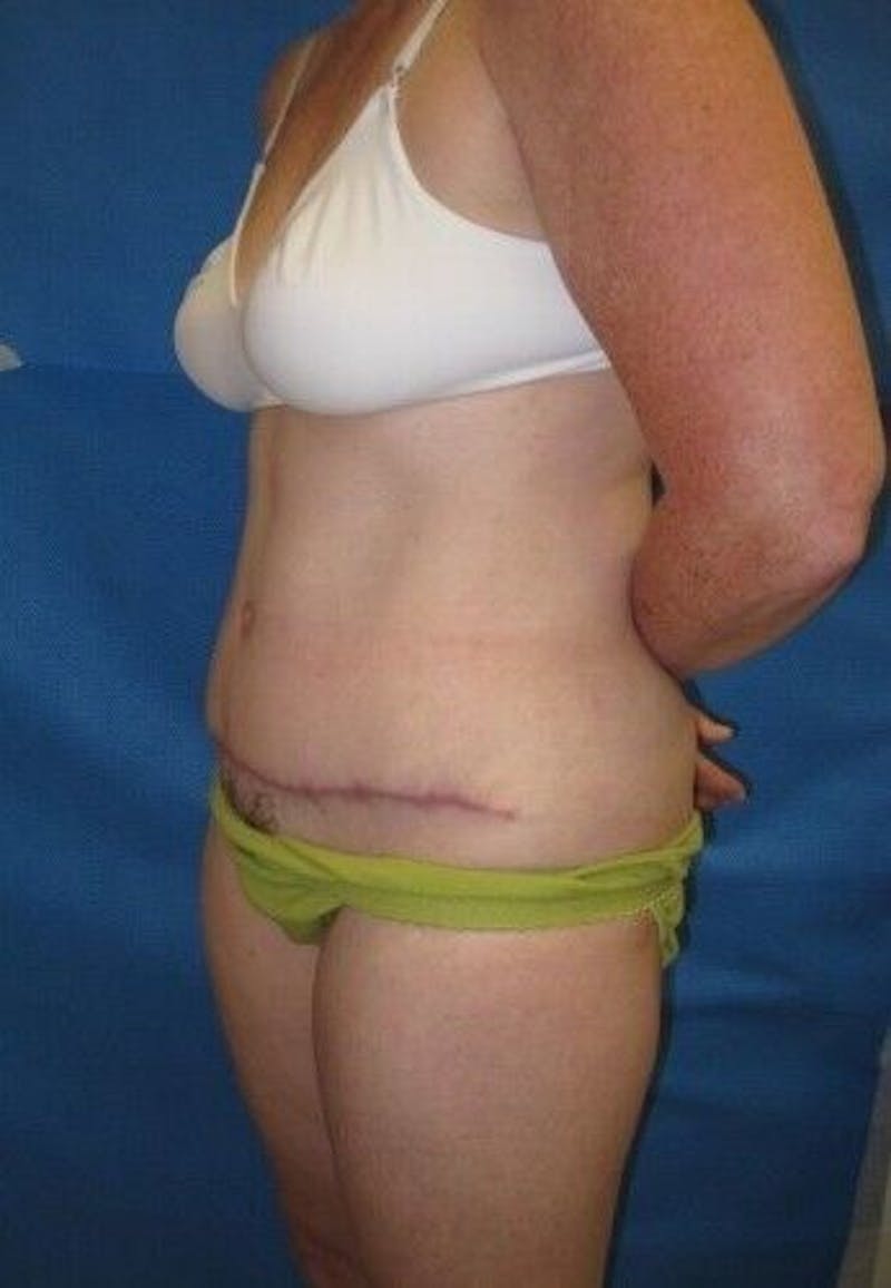 Tummy Tuck Before & After Gallery - Patient 55345582 - Image 4