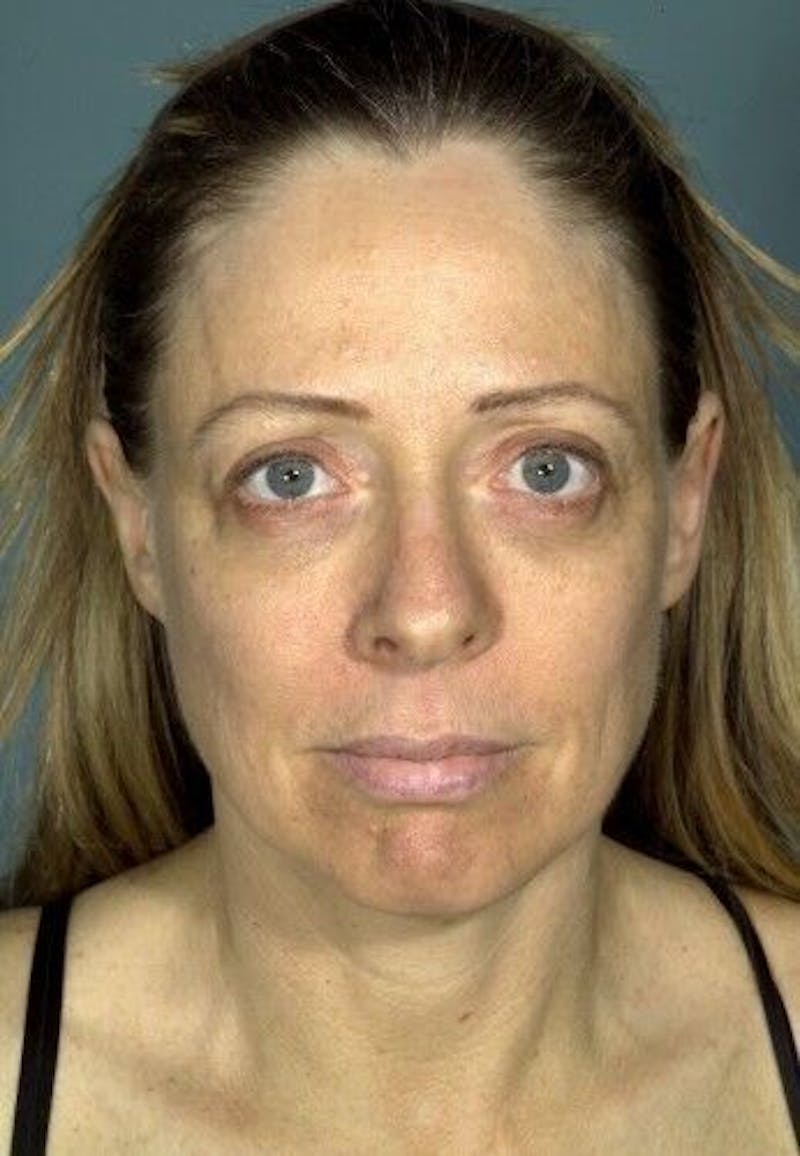 Facelift Before & After Gallery - Patient 55345578 - Image 1