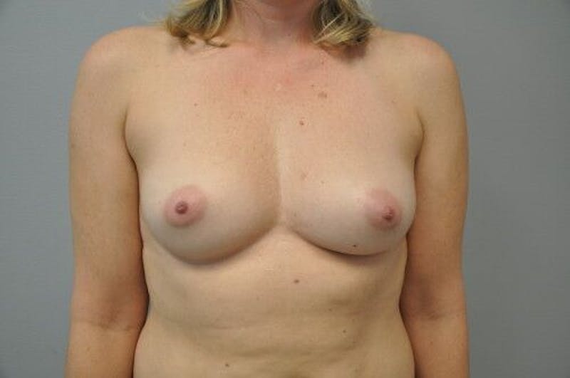 Breast Augmentation Before & After Gallery - Patient 55345588 - Image 1