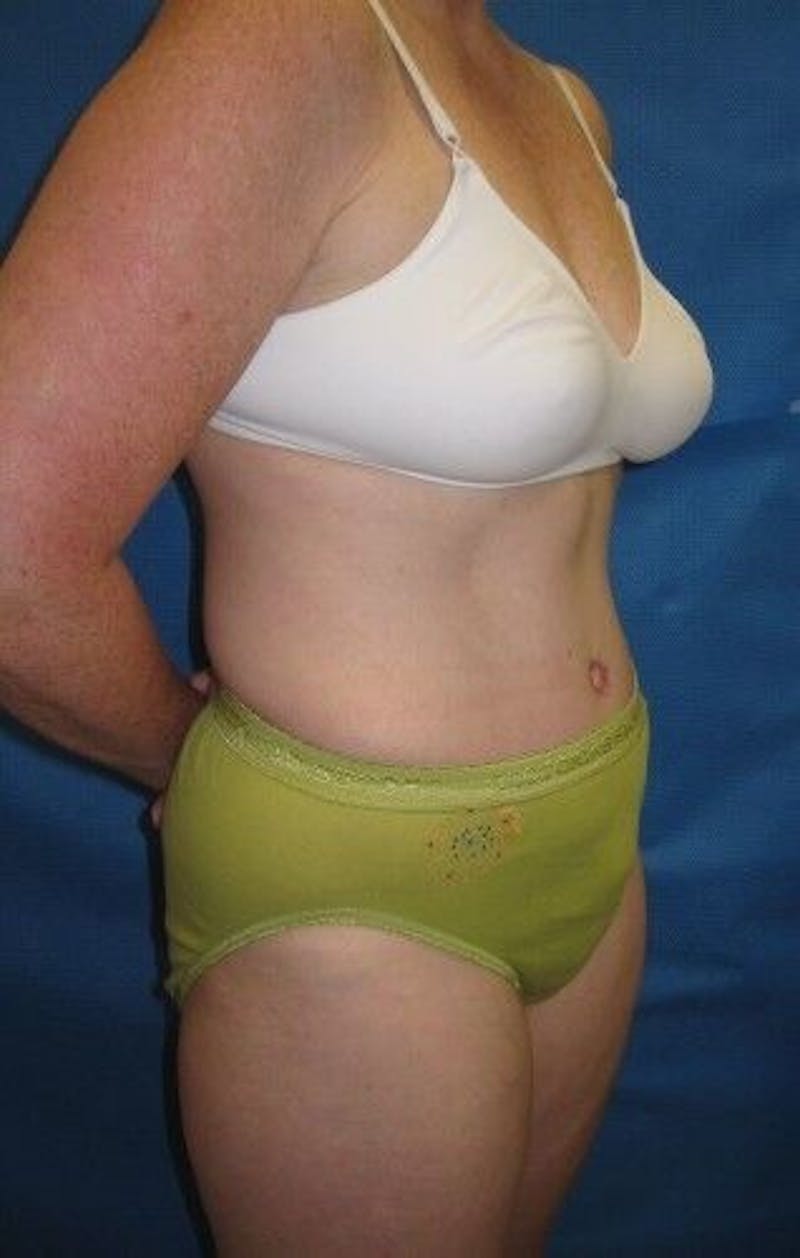Tummy Tuck Before & After Gallery - Patient 55345582 - Image 6