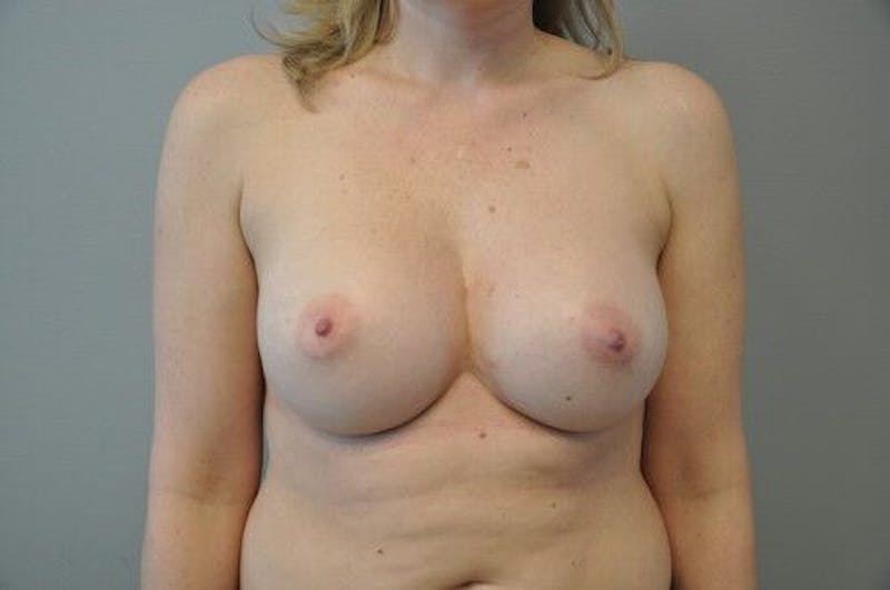 Breast Augmentation Before & After Gallery - Patient 55345588 - Image 2