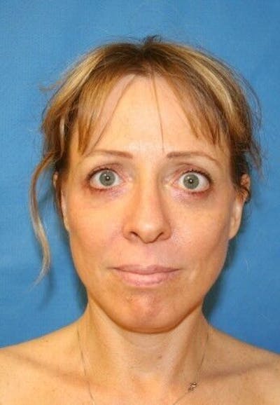 Facelift Before & After Gallery - Patient 55345578 - Image 2