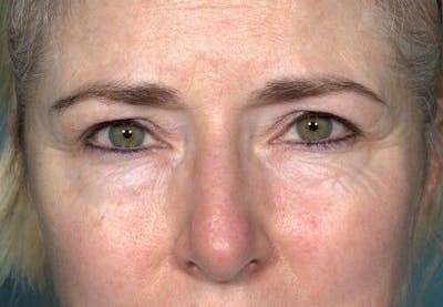 Eyelid Surgery Before & After Gallery - Patient 55345581 - Image 1