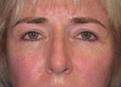 Eyelid Surgery Gallery - Patient 55345581 - Image 2