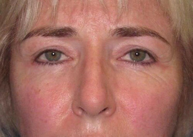 Eyelid Surgery Before & After Gallery - Patient 55345581 - Image 2