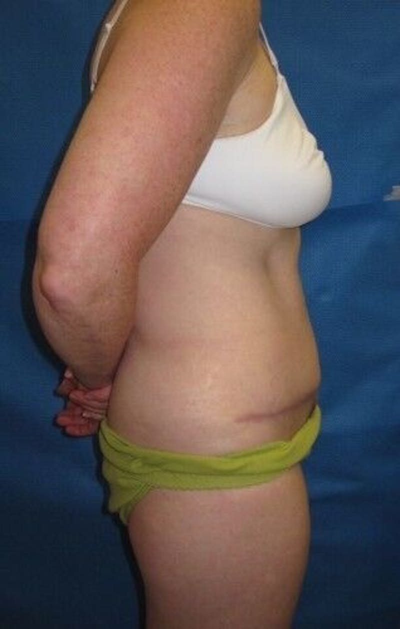 Tummy Tuck Before & After Gallery - Patient 55345582 - Image 8