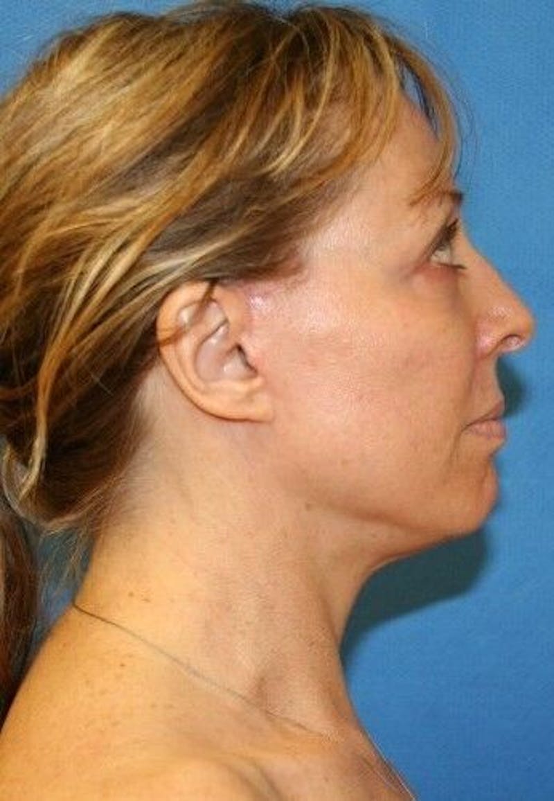 Facelift Before & After Gallery - Patient 55345578 - Image 4