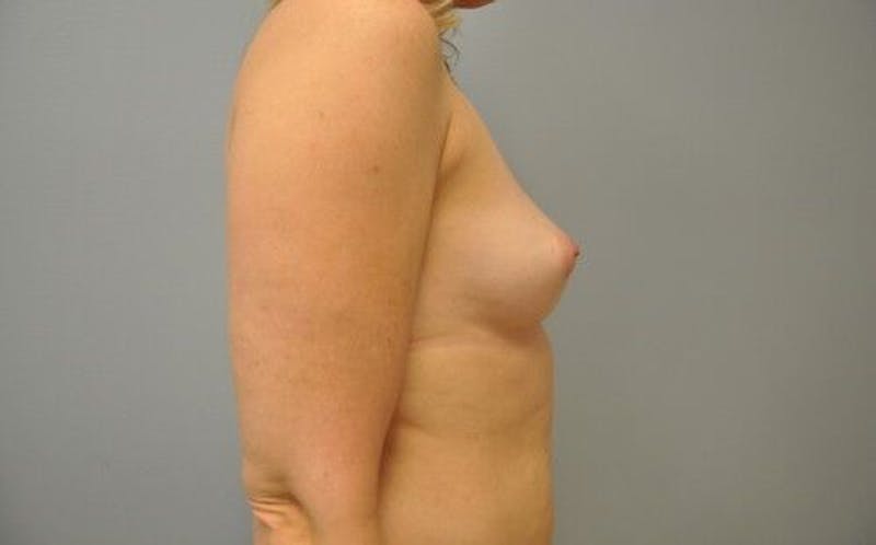 Breast Augmentation Before & After Gallery - Patient 55345588 - Image 5