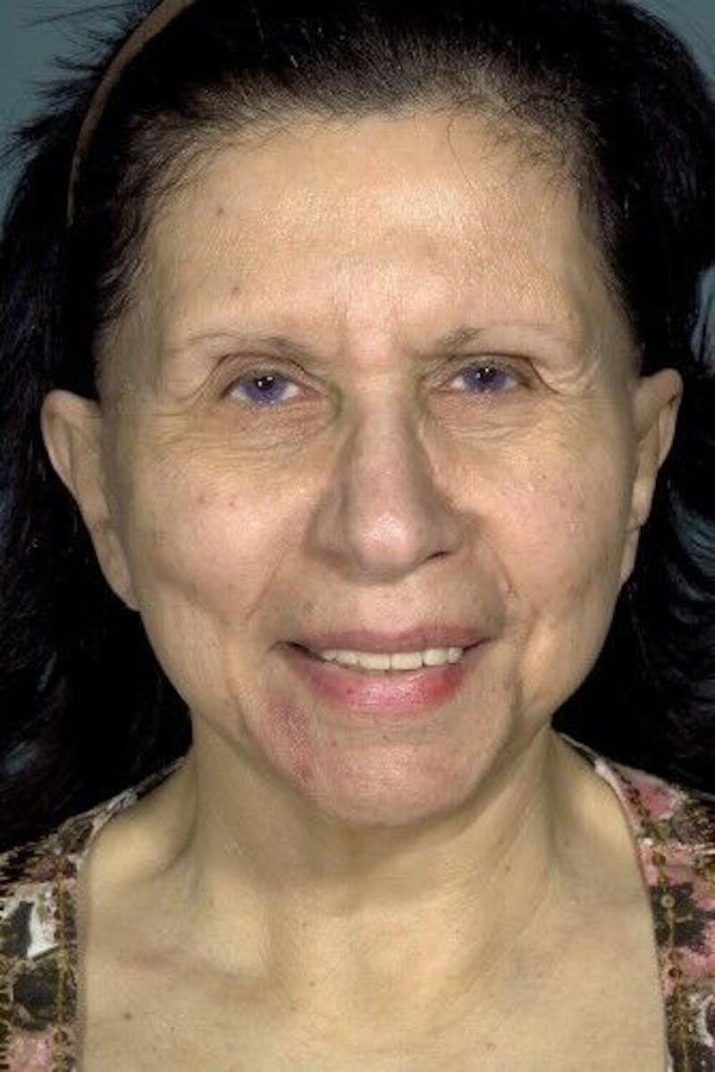 Facelift Before & After Gallery - Patient 55345586 - Image 1