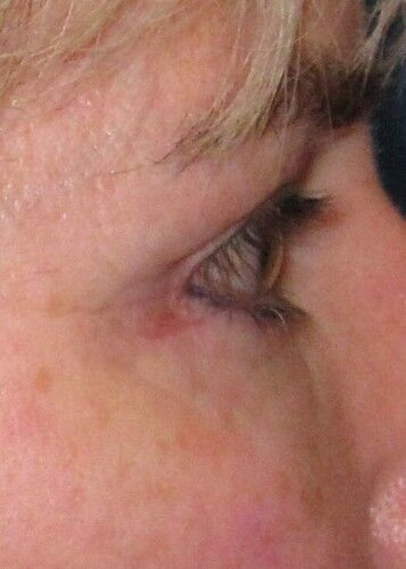 Eyelid Surgery Before & After Gallery - Patient 55345581 - Image 4