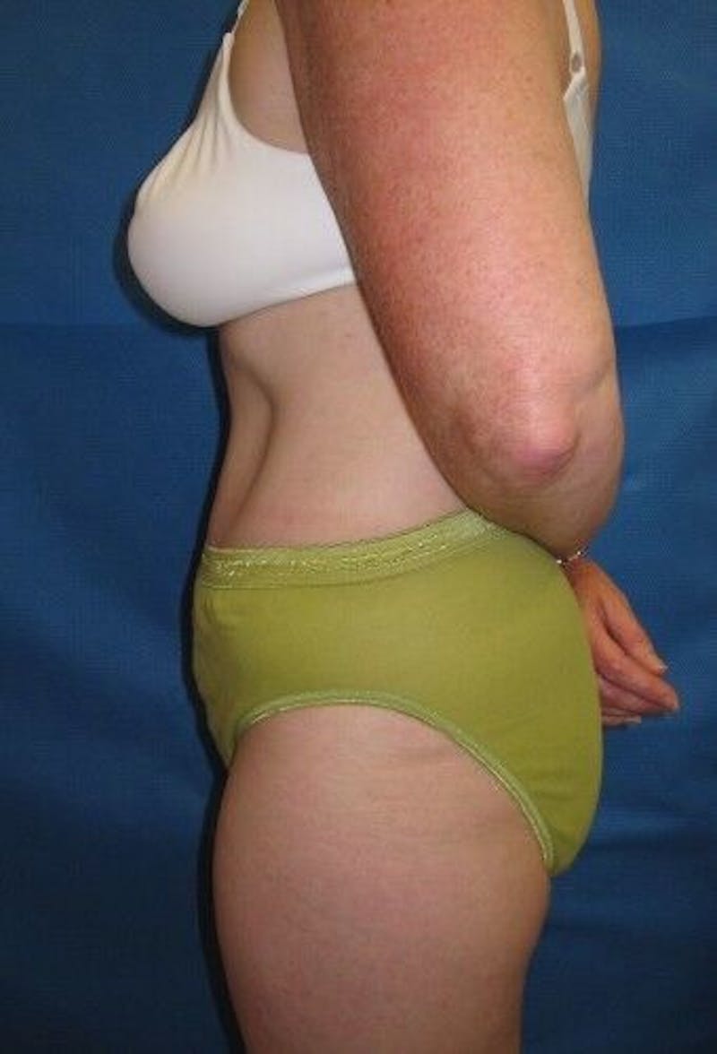 Tummy Tuck Before & After Gallery - Patient 55345582 - Image 10