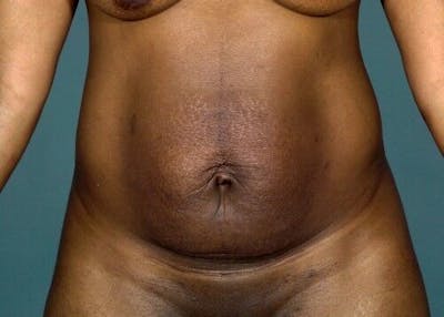 Tummy Tuck Before & After Gallery - Patient 55345593 - Image 1