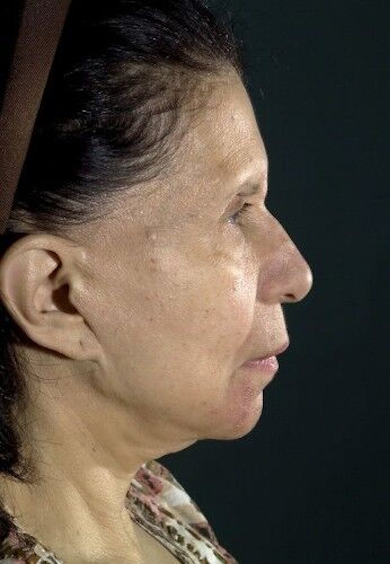 Facelift Before & After Gallery - Patient 55345586 - Image 3