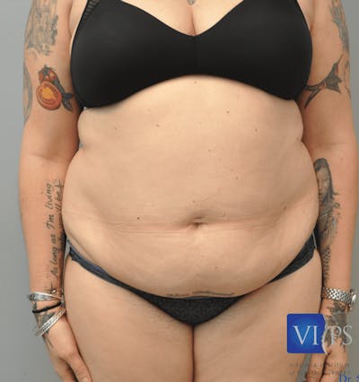 Liposuction Before & After Gallery - Patient 211876583 - Image 1