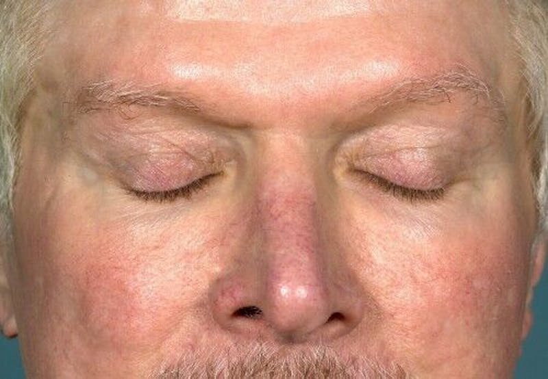 Eyelid Surgery Before & After Gallery - Patient 55345597 - Image 3