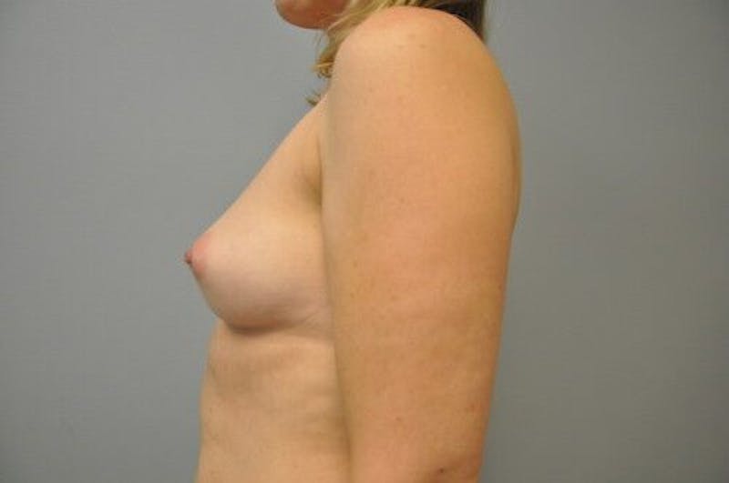 Breast Augmentation Before & After Gallery - Patient 55345588 - Image 9