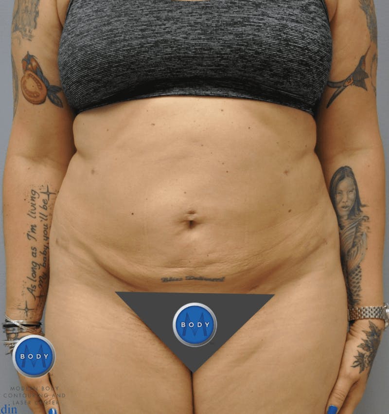 Liposuction Before & After Gallery - Patient 211876583 - Image 2