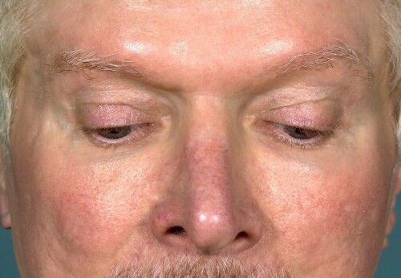 Eyelid Surgery Before & After Gallery - Patient 55345597 - Image 5