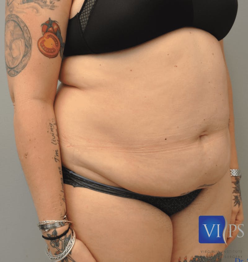 Liposuction Before & After Gallery - Patient 211876583 - Image 3