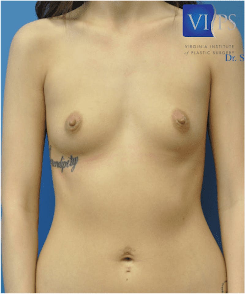 Breast Augmentation Before & After Gallery - Patient 55345601 - Image 1