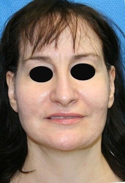 Facelift Before & After Gallery - Patient 55345595 - Image 2