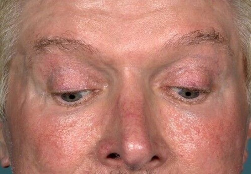 Eyelid Surgery Before & After Gallery - Patient 55345597 - Image 6
