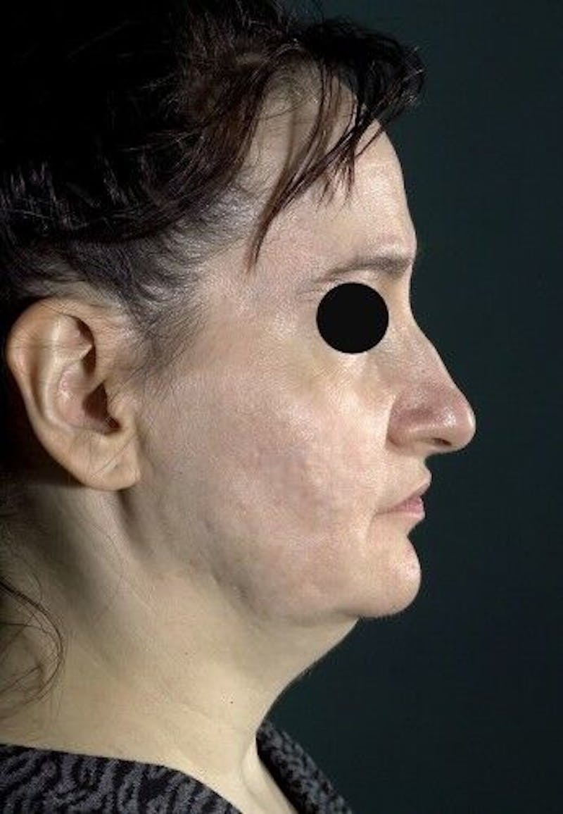 Facelift Before & After Gallery - Patient 55345595 - Image 3
