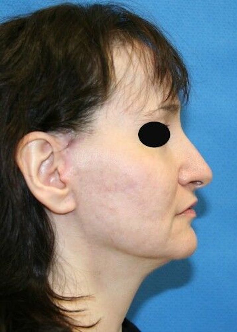Facelift Before & After Gallery - Patient 55345595 - Image 4