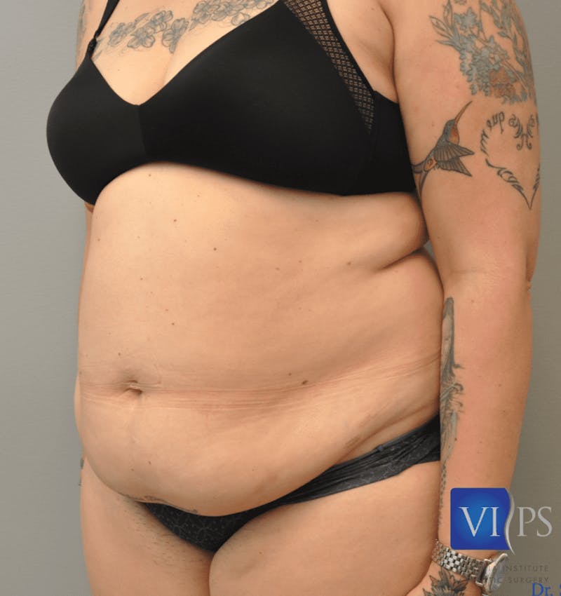 Liposuction Before & After Gallery - Patient 211876583 - Image 5