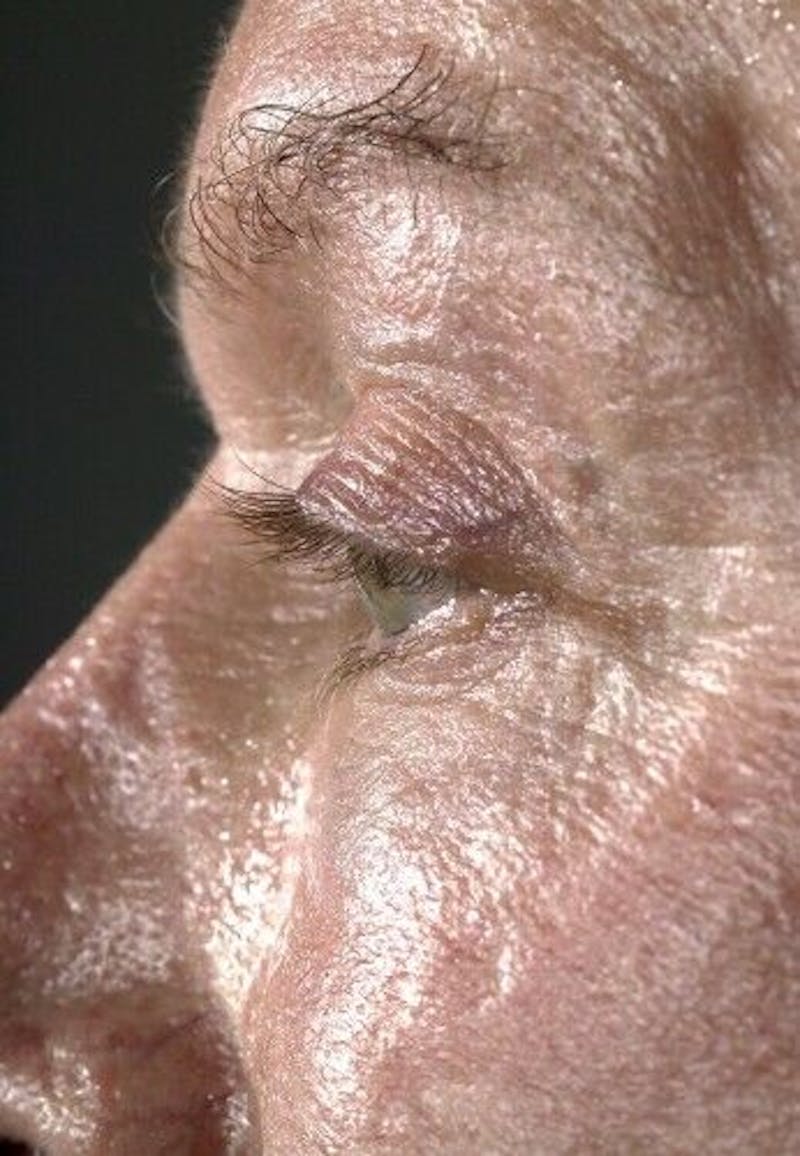 Eyelid Surgery Before & After Gallery - Patient 55345597 - Image 8