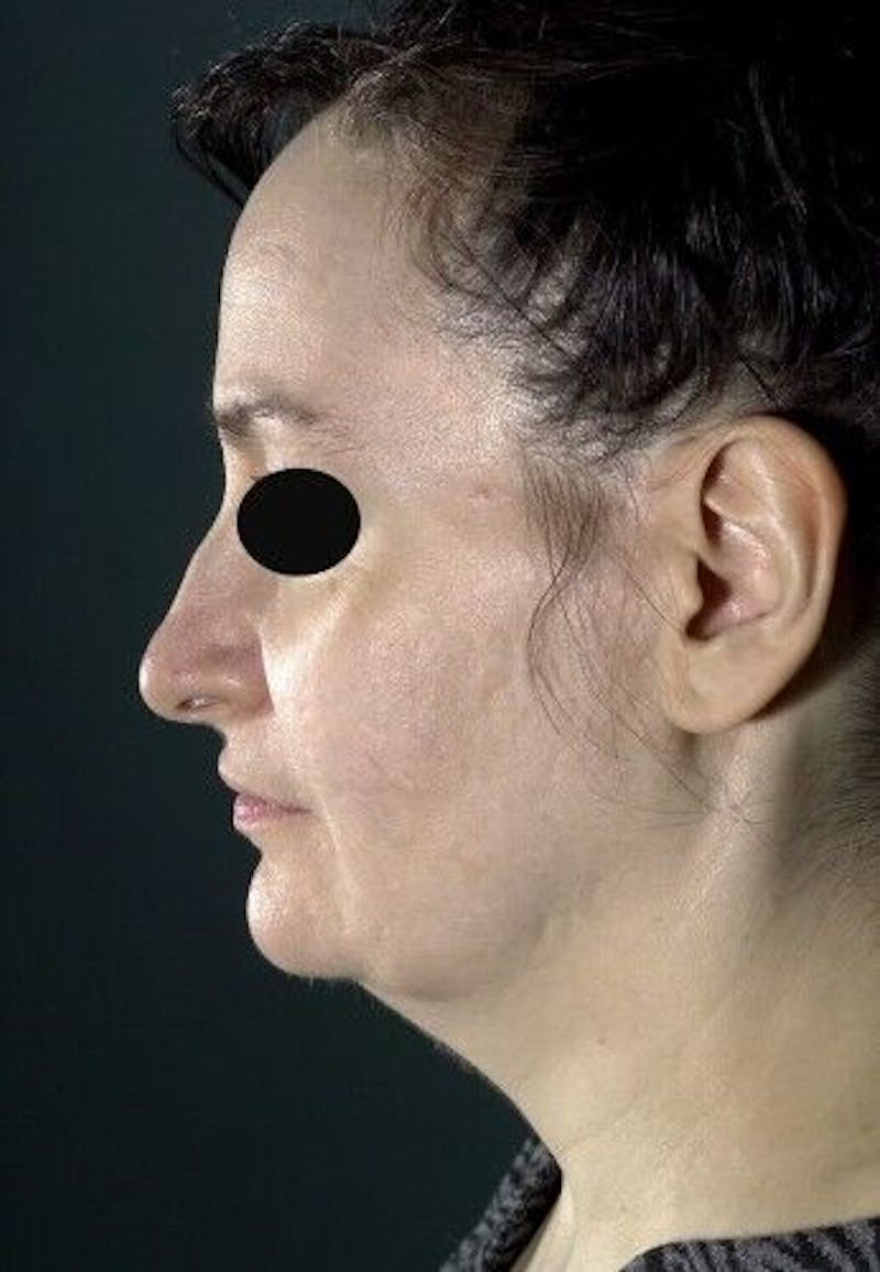 Facelift Before & After Gallery - Patient 55345595 - Image 5