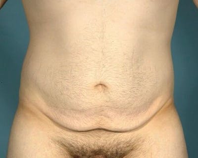 Tummy Tuck Before & After Gallery - Patient 55345603 - Image 1