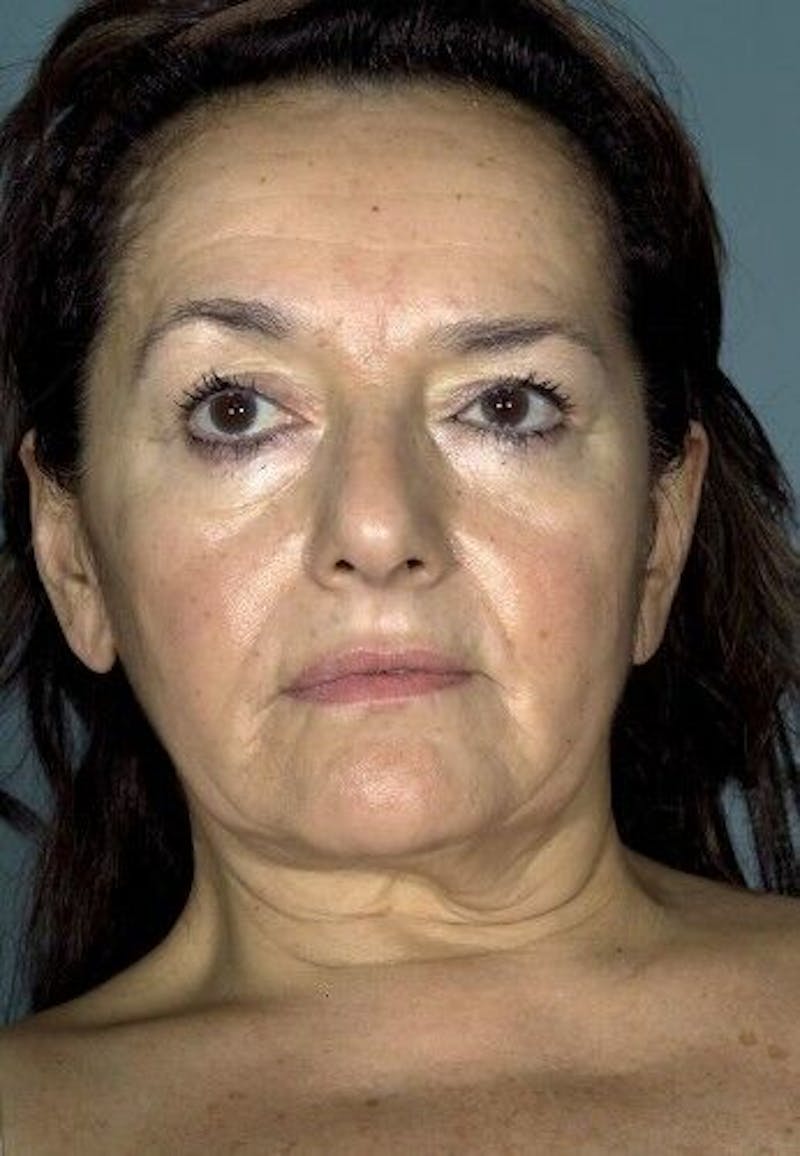 Facelift Before & After Gallery - Patient 55345600 - Image 1