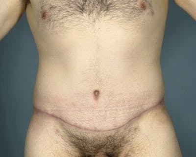 Tummy Tuck Before & After Gallery - Patient 55345603 - Image 2