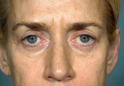 Eyelid Surgery Before & After Gallery - Patient 55345611 - Image 1