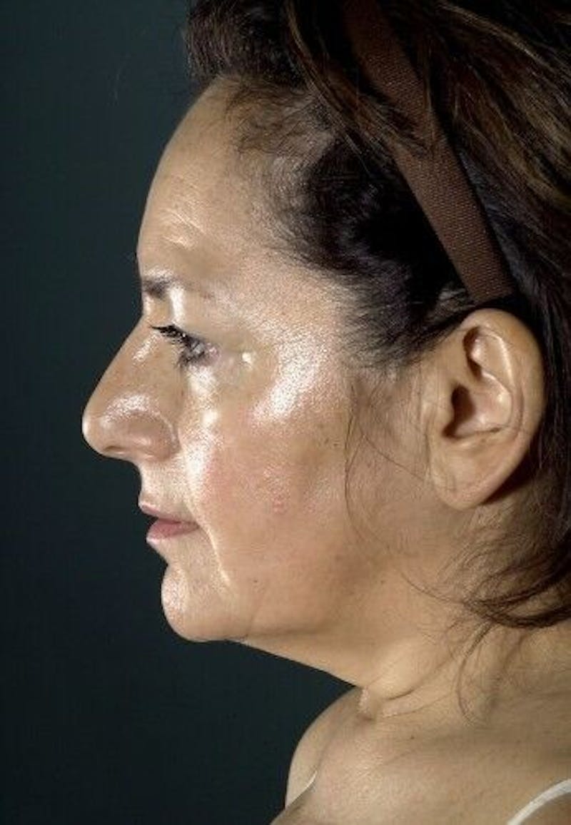 Facelift Before & After Gallery - Patient 55345600 - Image 3