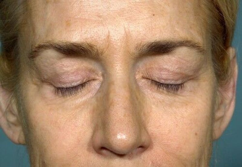 Eyelid Surgery Before & After Gallery - Patient 55345611 - Image 3