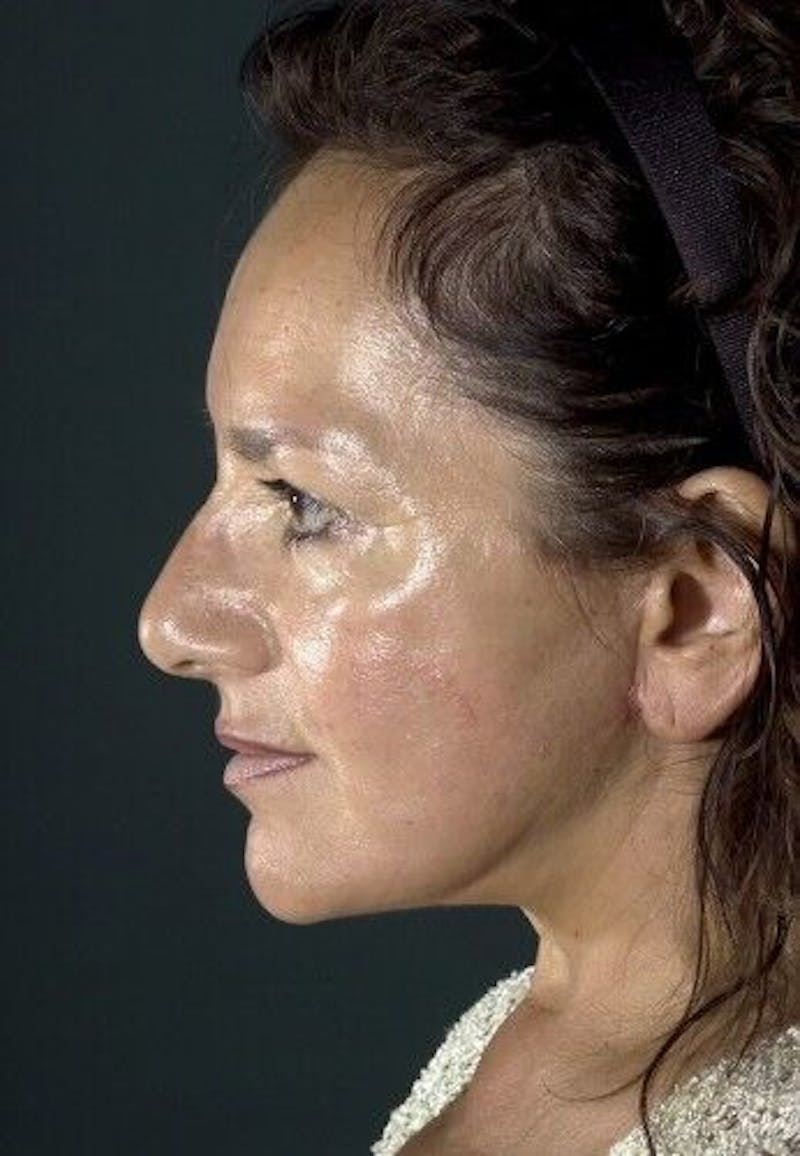 Facelift Before & After Gallery - Patient 55345600 - Image 4