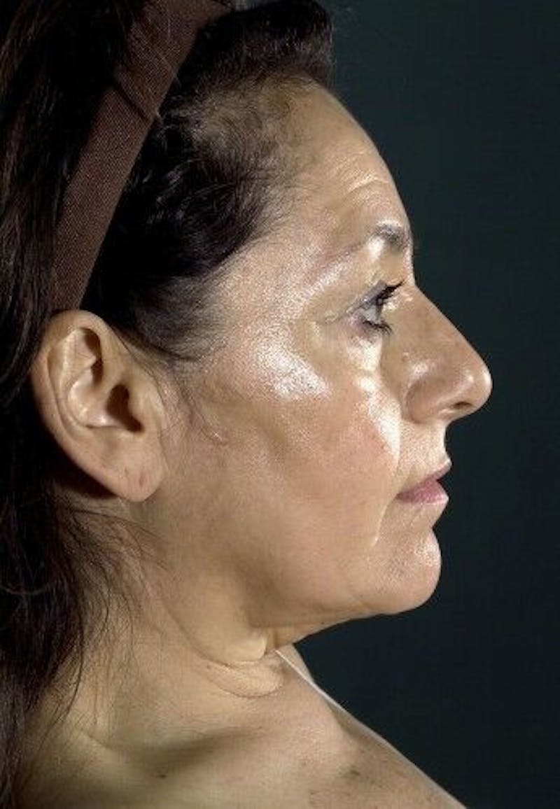 Facelift Before & After Gallery - Patient 55345600 - Image 5
