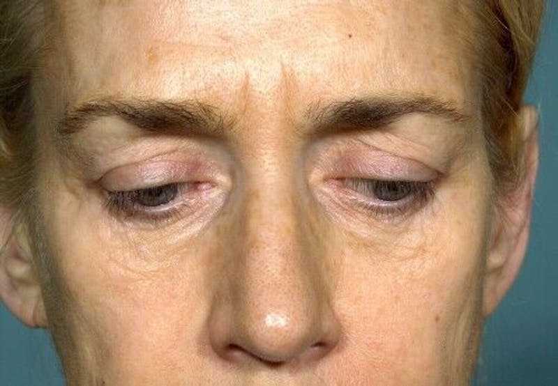 Eyelid Surgery Before & After Gallery - Patient 55345611 - Image 5