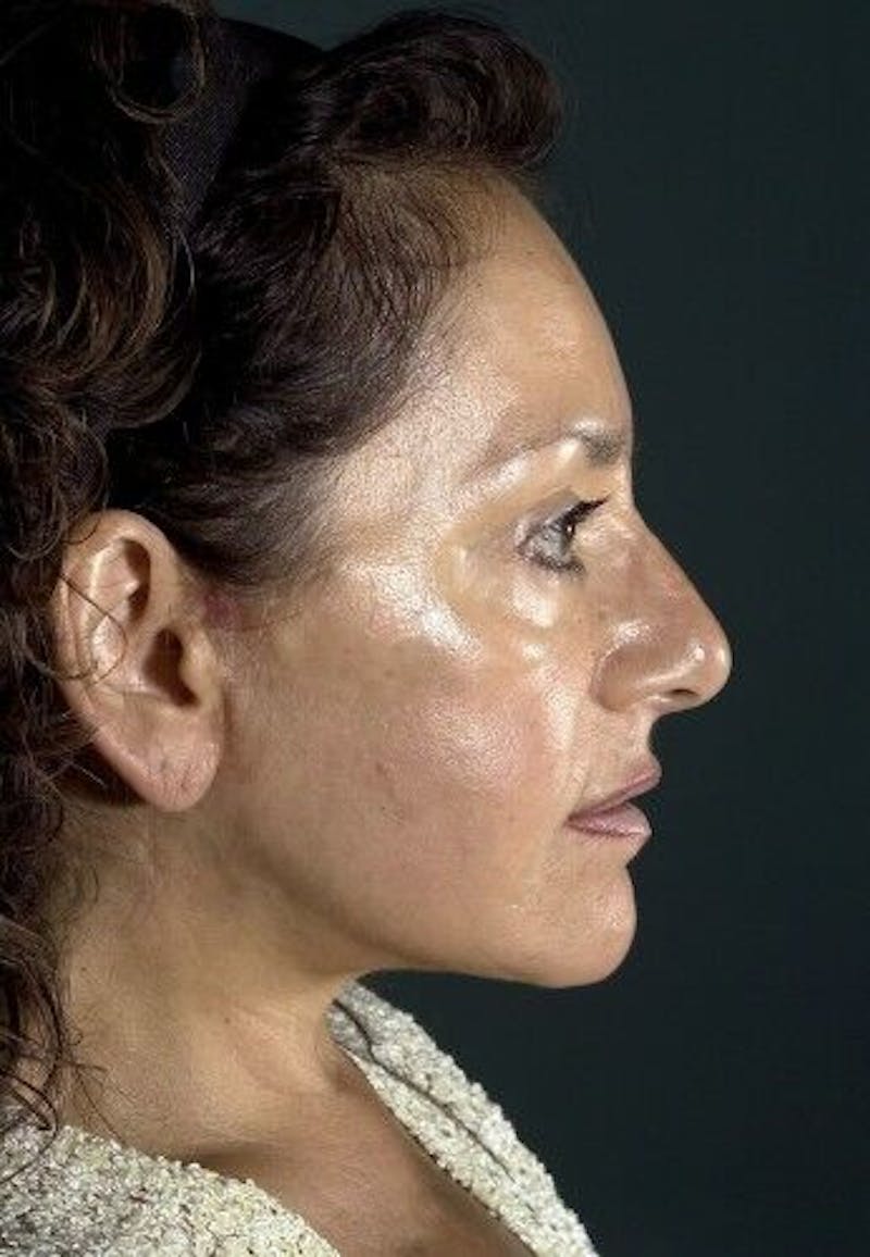 Facelift Before & After Gallery - Patient 55345600 - Image 6