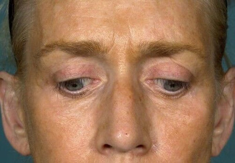 Eyelid Surgery Before & After Gallery - Patient 55345611 - Image 6