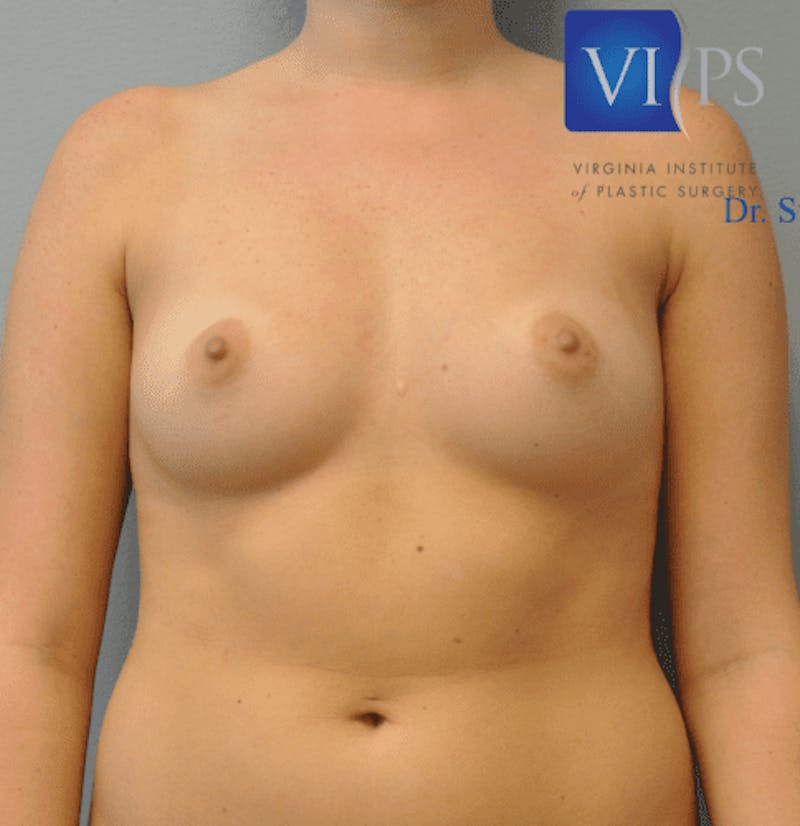 Breast Augmentation Before & After Gallery - Patient 55345614 - Image 1