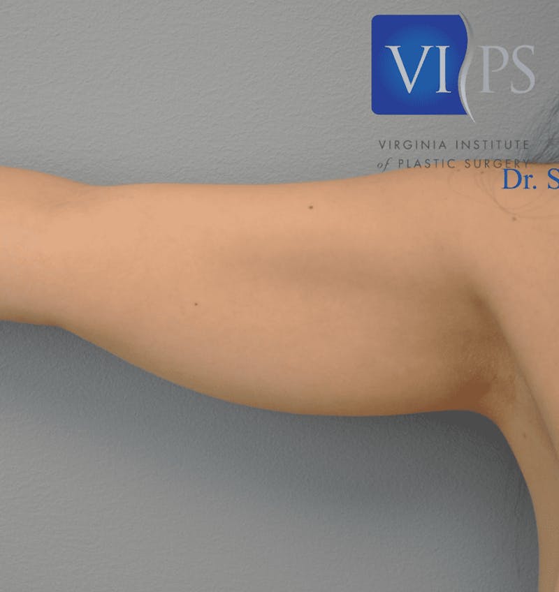 Liposuction Before & After Gallery - Patient 211876621 - Image 1