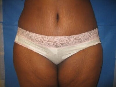 Tummy Tuck Before & After Gallery - Patient 55345616 - Image 2