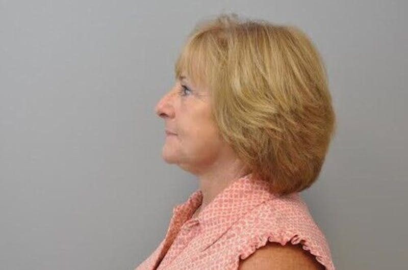 Facelift Before & After Gallery - Patient 55345613 - Image 4