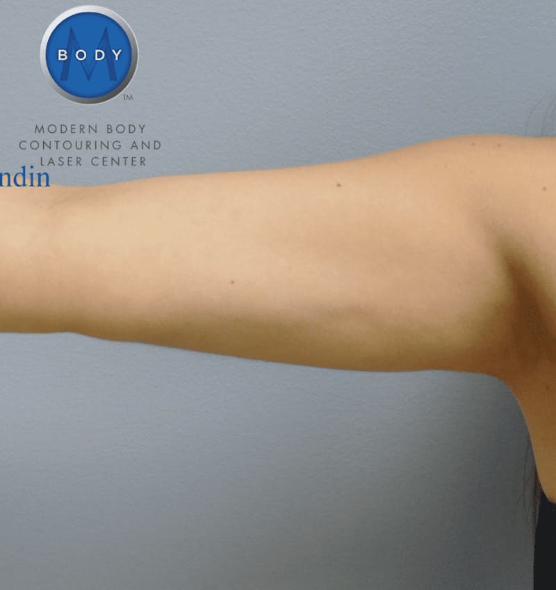 Liposuction Before & After Gallery - Patient 211876621 - Image 2
