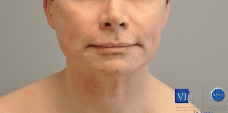 Facelift Before & After Gallery - Patient 55345621 - Image 1