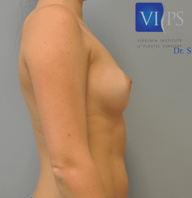 Breast Augmentation Before & After Gallery - Patient 55345614 - Image 5